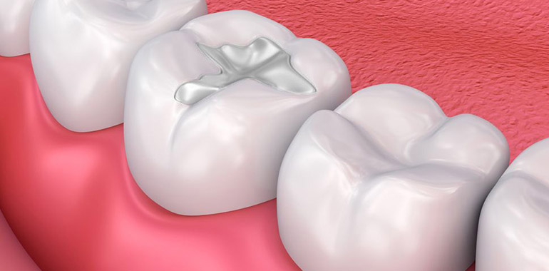 top dental filling services in pimple saudagar